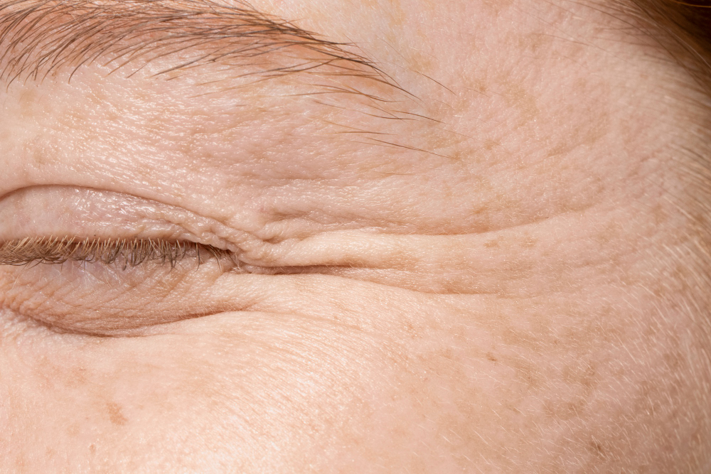 Rides autour des yeux visibles au niveau du contour oculaire