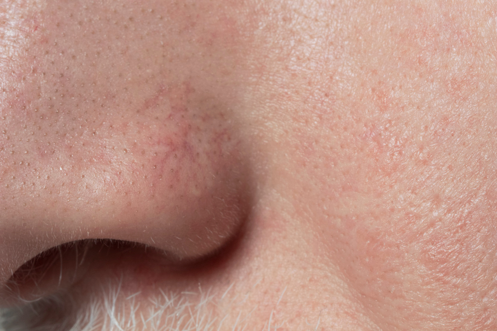 Pores dilatés et texture de peau irrégulière au niveau du visage