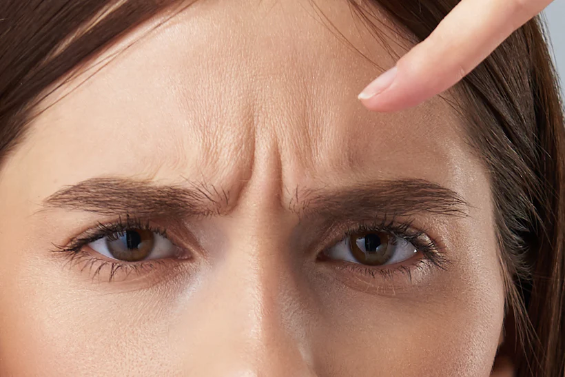 Rides d’expression visibles entre les sourcils au niveau du front