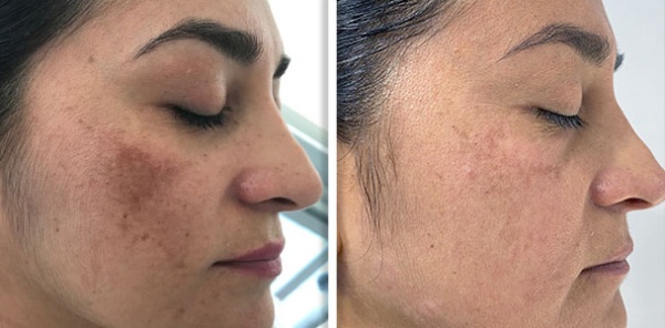 Melasma before and after result 2
