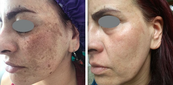 Melasma before and after result 3
