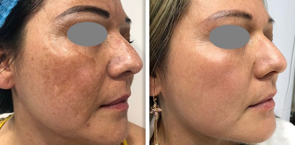 Melasma before and after result 4